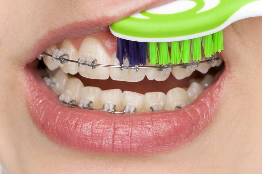Zahnfleischentzündungen durch Zahnspangen mit richtiger Pflege vermeiden
