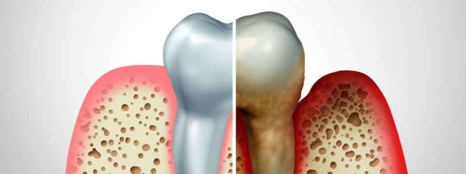 Zahnbelag, Plaque, Zahnstein, Bakterien, Parodontitis, Entzündung, Zahnfleisch
